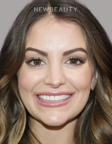Dr. Salvator La Mastra V gum reshaping after — Dallas, TX