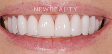 Dr. Salvator La Mastra V gum reshaping after — Dallas, TX