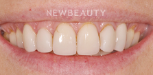 Gum Contouring before at Dr. Salvator La Mastra V in Dallas, TX