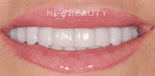 Dr. Salvator La Mastra V smile makeover after — Dallas, TX