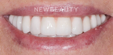 Dr. Salvator La Mastra V dental implants after — Dallas, TX
