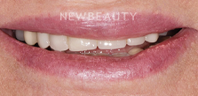 Dental Implants before at Dr. Salvator La Mastra V in Dallas, TX