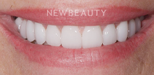 Dr. Salvator La Mastra V gum reshaping after — Dallas, TX