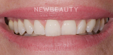 Gum Contouring before at Dr. Salvator La Mastra V in Dallas, TX