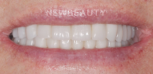Dr. Salvator La Mastra V dental crowns after — Dallas, TX