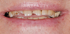 Dental Crowns before at Dr. Salvator La Mastra V in Dallas, TX