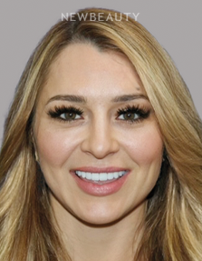 Dr. Salvator La Mastra V gum reshaping after — Dallas, TX