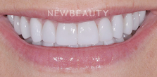 Dr. Salvator La Mastra V dental crowns after — Dallas, TX