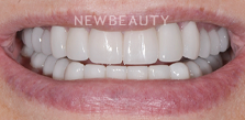 Dr. Salvator La Mastra V dental crowns after — Dallas, TX
