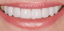 Dr. Salvator La Mastra V smile makeover after — Dallas, TX