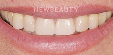 Smile Makeover before at Dr. Salvator La Mastra V in Dallas, TX