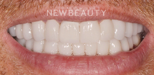 Dr. Salvator La Mastra V dental crowns after — Dallas, TX