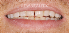 Dental Crowns before at Dr. Salvator La Mastra V in Dallas, TX