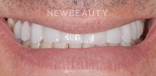 Dr. Salvator La Mastra V gum reshaping after — Dallas, TX