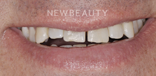 Gum Contouring before at Dr. Salvator La Mastra V in Dallas, TX