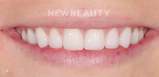 Dr. Salvator La Mastra V smile makeover after — Dallas, TX
