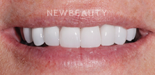 Dr. Salvator La Mastra V dental crowns after — Dallas, TX