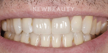 Dr. Salvator La Mastra V gum reshaping after — Dallas, TX