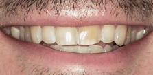 Gum Contouring before at Dr. Salvator La Mastra V in Dallas, TX
