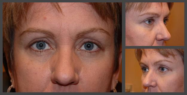 Plastic Surgery for Eyes after — Sandy, UT