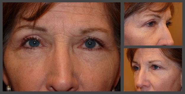 Plastic Surgery for Eyes eyelid lift after — Sandy, UT