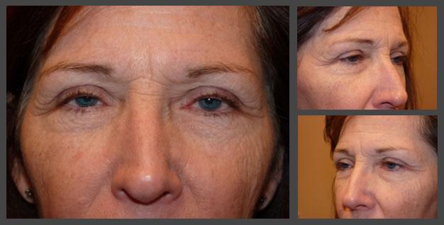 Blepharoplasty before at Plastic Surgery for Eyes in Sandy, UT