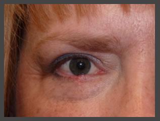 Blepharoplasty after at Plastic Surgery for Eyes in Sandy, UT