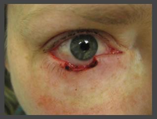 Blepharoplasty before at Plastic Surgery for Eyes in Sandy, UT