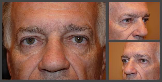 Plastic Surgery for Eyes eyelid lift after — Sandy, UT