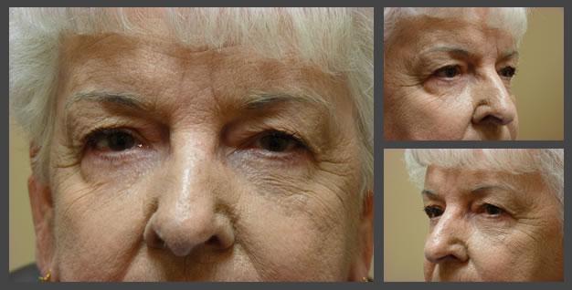 Plastic Surgery for Eyes blepharoplasty after — Sandy, UT