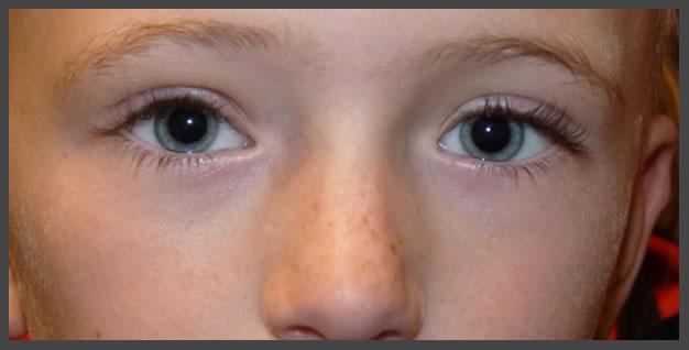 Plastic Surgery for Eyes after — Sandy, UT