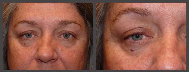 Plastic Surgery for Eyes eyelid lift after — Sandy, UT