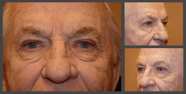 Plastic Surgery for Eyes blepharoplasty after — Sandy, UT