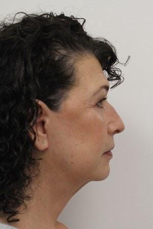 Petroff Center Plastic Surgery and Medi-Spa facelift after — Lake Oswego, OR