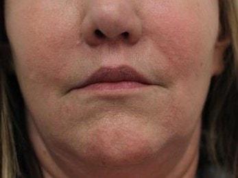 Petroff Center Plastic Surgery and Medi-Spa lip lift after — Lake Oswego, OR