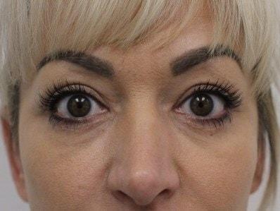 Petroff Center Plastic Surgery and Medi-Spa eyelid lift after — Lake Oswego, OR