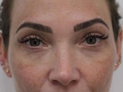 Petroff Center Plastic Surgery and Medi-Spa eyelid lift after — Lake Oswego, OR