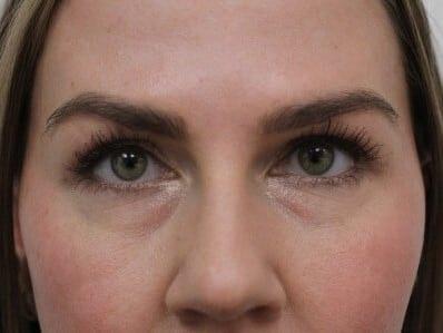 Petroff Center Plastic Surgery and Medi-Spa eyelid lift after — Lake Oswego, OR