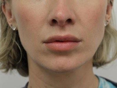 Petroff Center Plastic Surgery and Medi-Spa lip lift after — Lake Oswego, OR