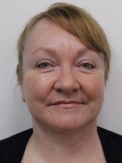 Petroff Center Plastic Surgery and Medi-Spa facelift after — Lake Oswego, OR