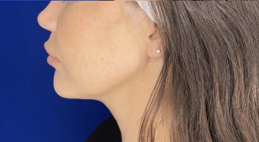 San Diego Aesthetics and Med Spa jawline filler after — La Mesa, CA