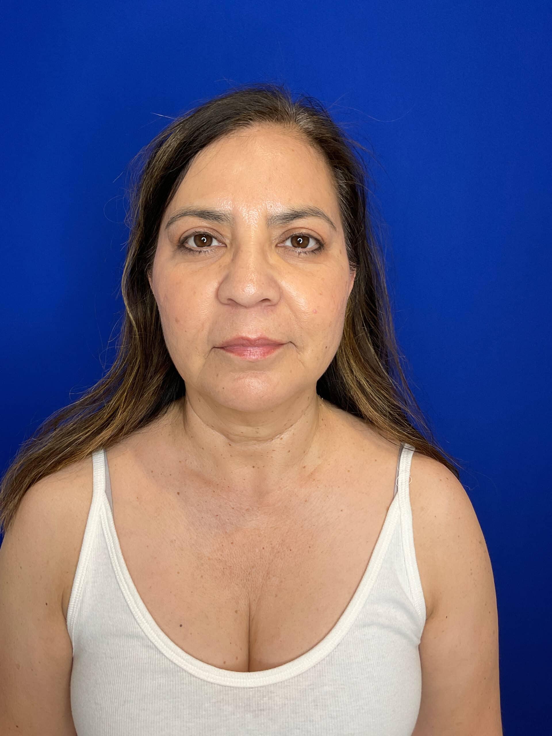 San Diego Aesthetics and Med Spa after — La Mesa, CA