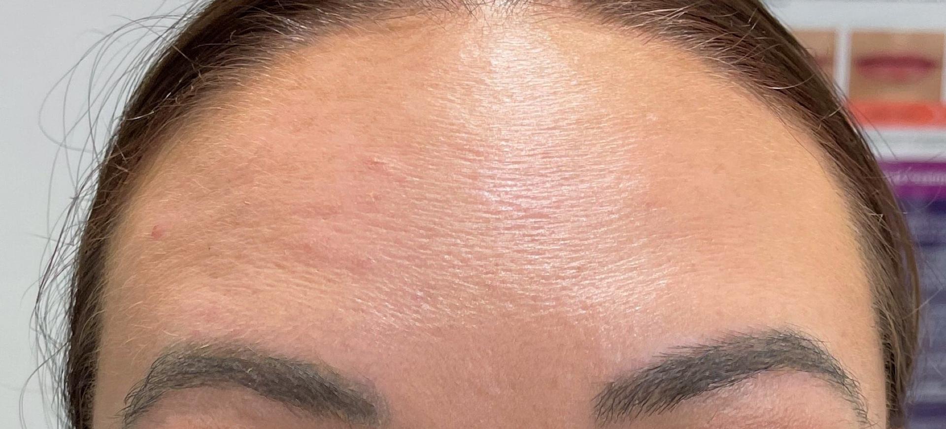 San Diego Aesthetics and Med Spa botox after — La Mesa, CA