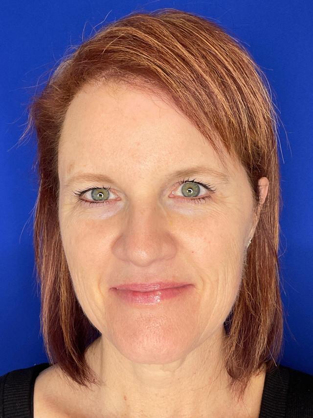 Microneedling after at San Diego Aesthetics and Med Spa in La Mesa, CA