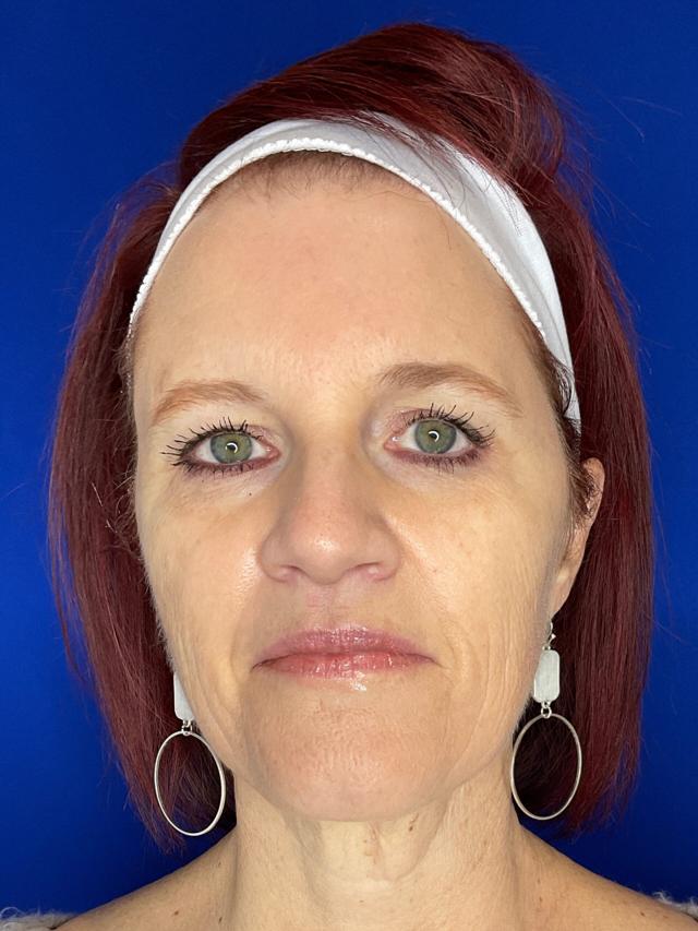 Microneedling before at San Diego Aesthetics and Med Spa in La Mesa, CA