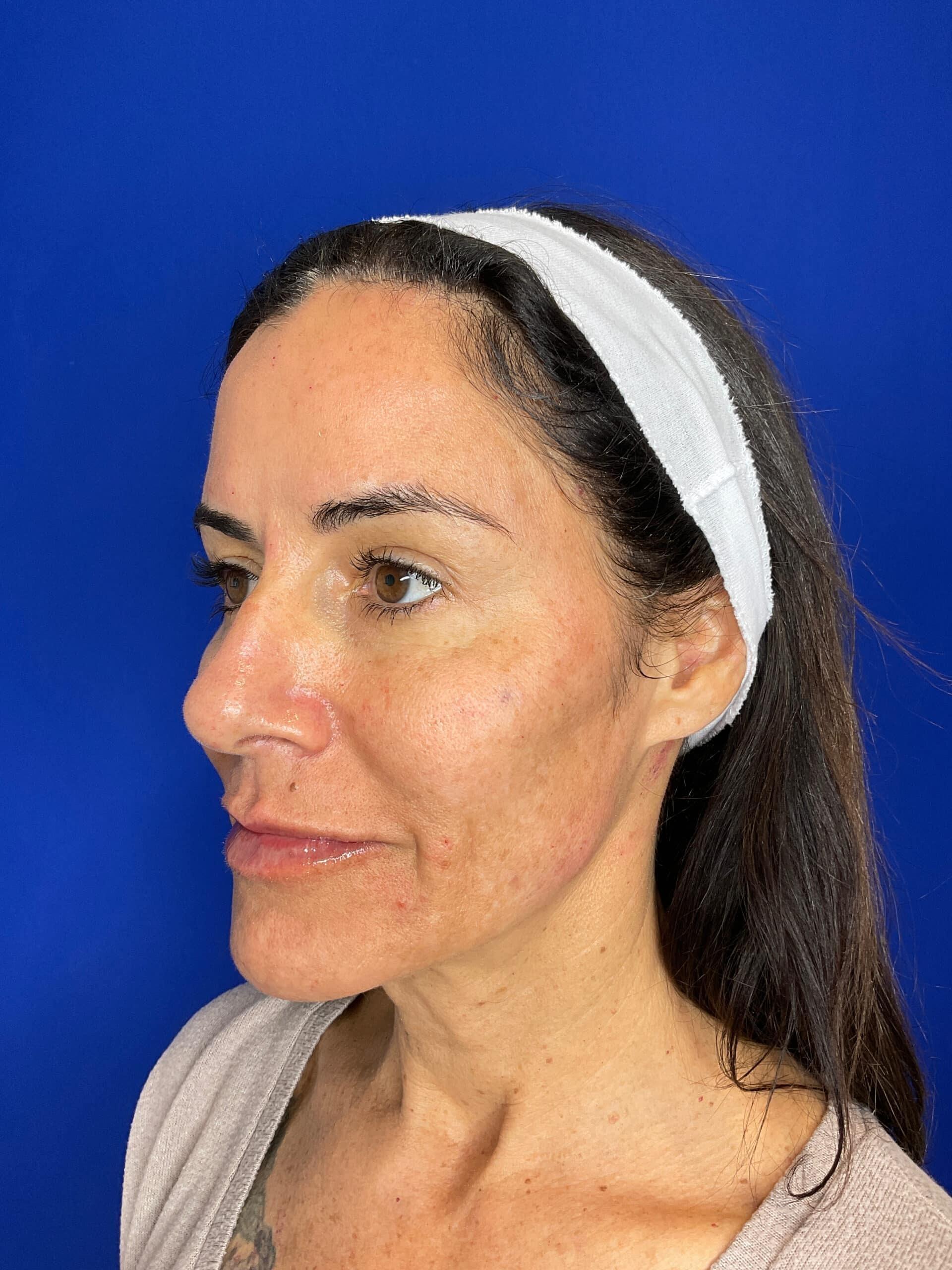 San Diego Aesthetics and Med Spa lip filler after — La Mesa, CA