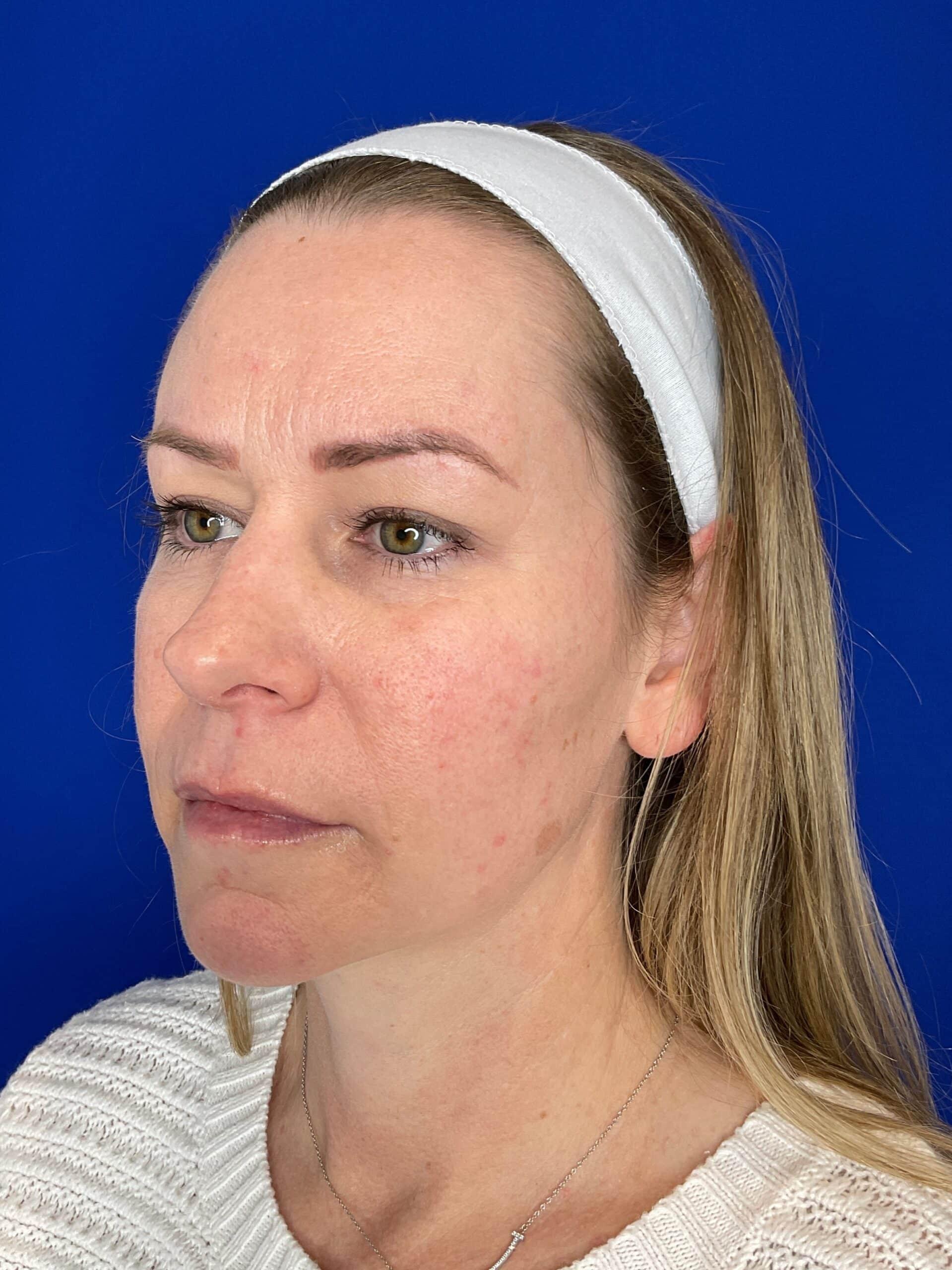 San Diego Aesthetics and Med Spa after — La Mesa, CA
