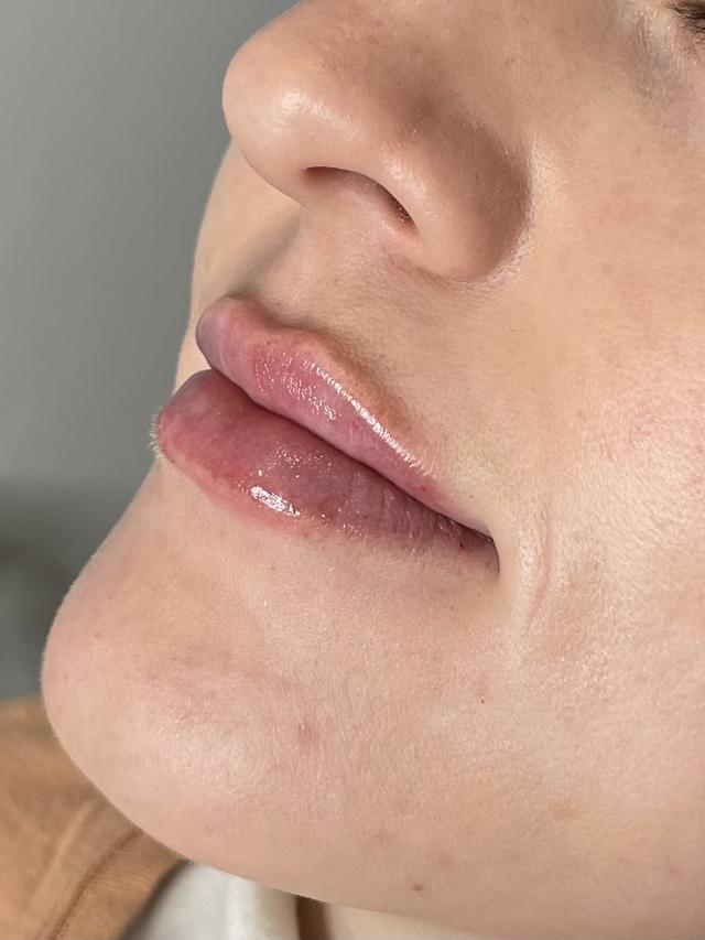 Lip Filler after at San Diego Aesthetics and Med Spa in La Mesa, CA