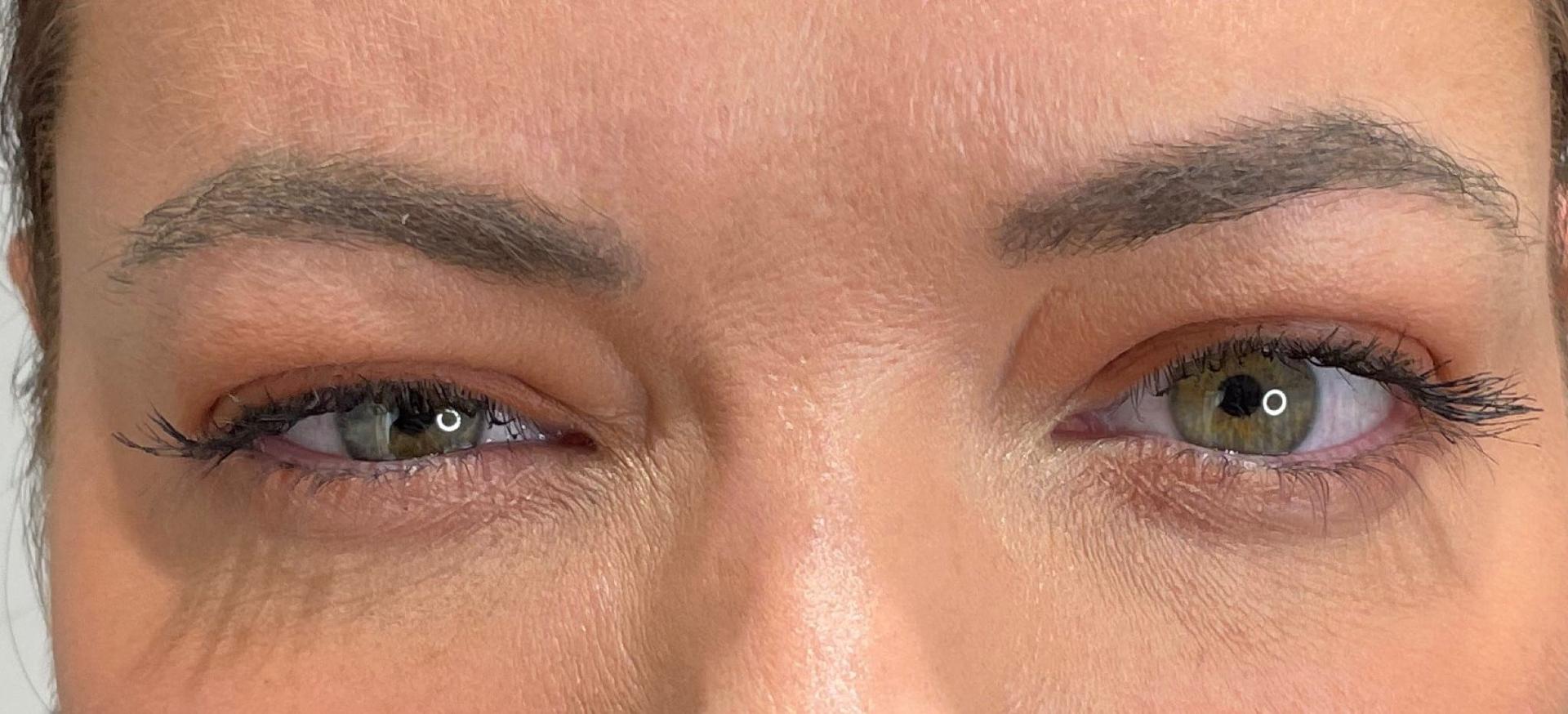 San Diego Aesthetics and Med Spa botox after — La Mesa, CA