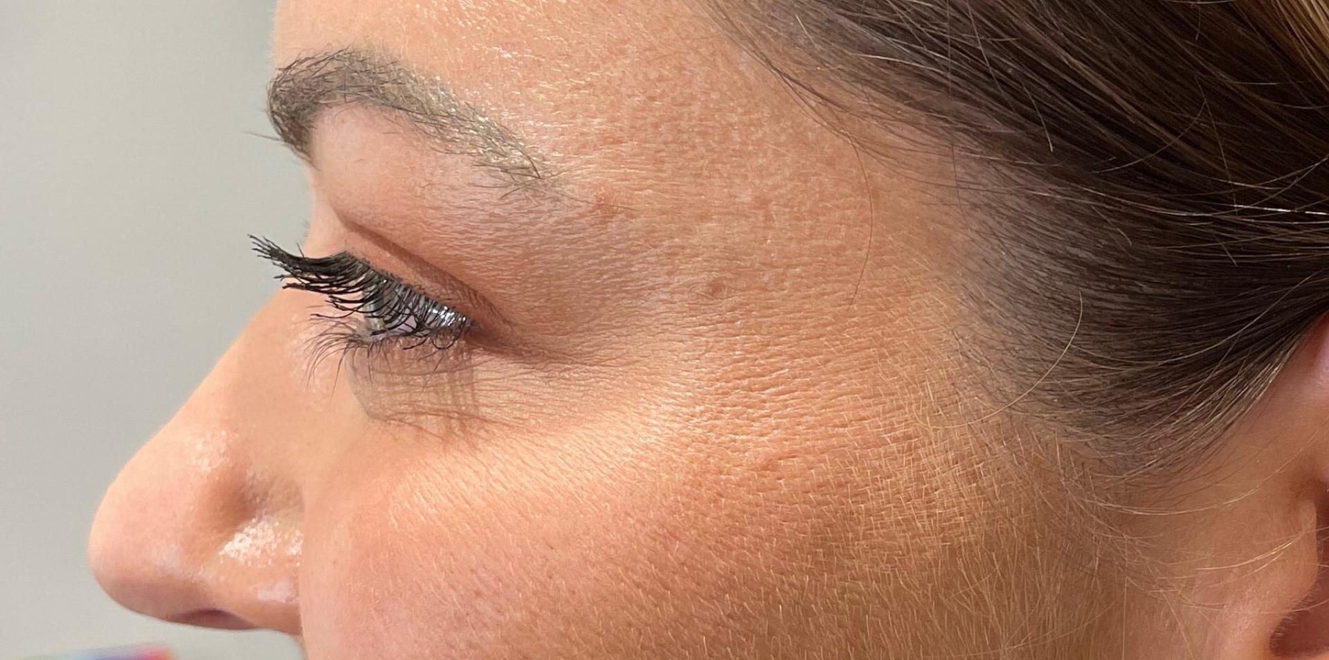 San Diego Aesthetics and Med Spa botox after — La Mesa, CA
